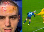 Nikola Krstović de l'Atalanta montre son front apr&egrave;s le penalty dramatique de derni&egrave;re minute contre le BVB.